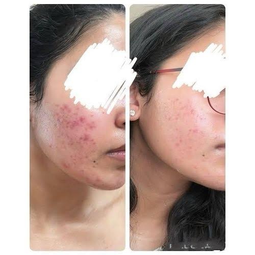 Anua Azelaic Acid 10 Hyaluron Redness Soothing Serum apaisant 30ml